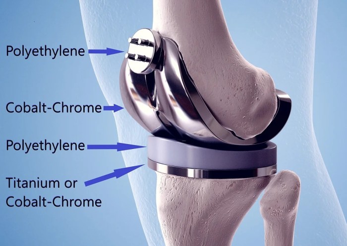 Centurion Orthopaedic Centre What are TKR implants made of? - Centurion ...